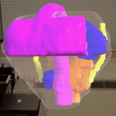 MiguelDlaCamara's tweet photo. El ejemplo de lo que dije en Congreso #Seram2018 

No hace falta imprimir todo para que #Cirugía analice abordaje previo. La computación de imagen de #Radiologia usando #RealidadAumentada reduce costes por caso 

https://t.co/Nw06h9zawb
Via @AuntMinnie 

Pero claro, soy #TSID https://t.co/8nFOS2Dxgp
