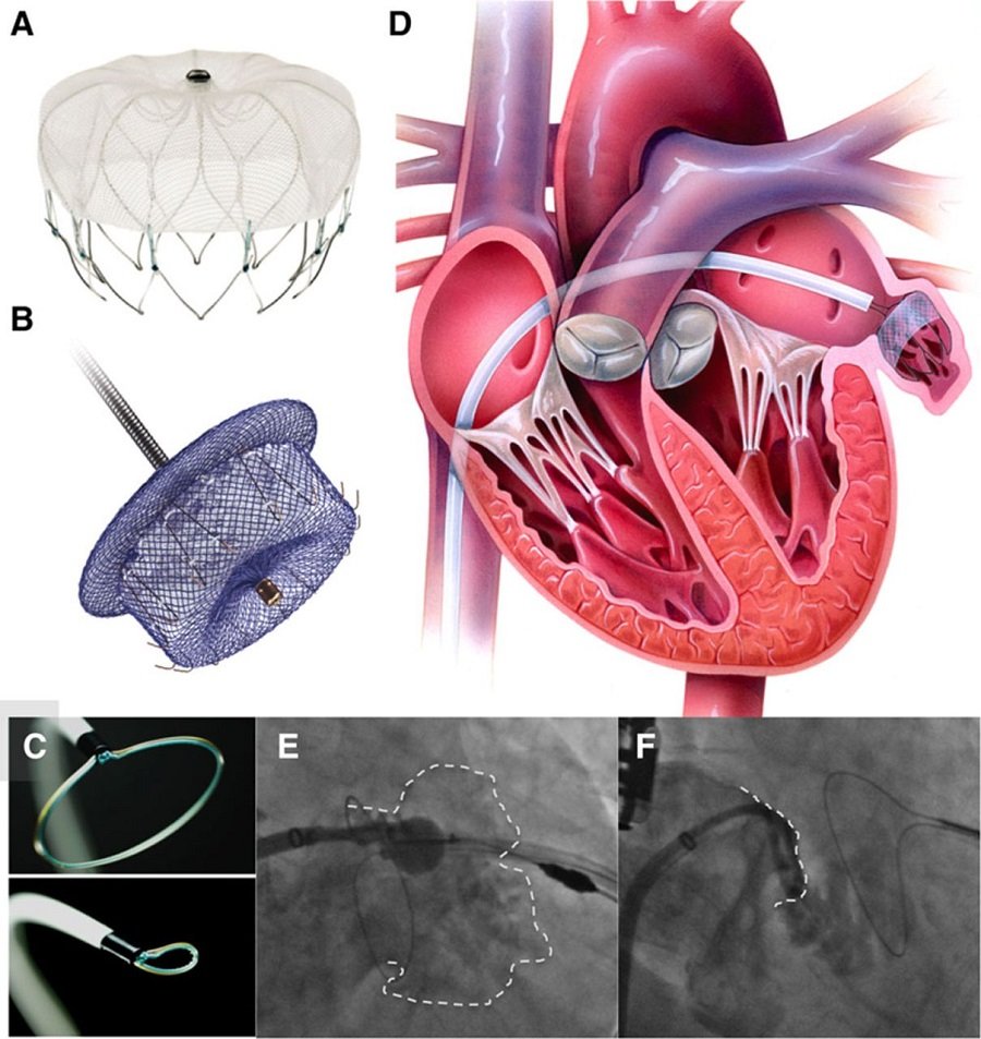 ArieBlitzMD's tweet photo. Amplatzer Amulet slashes stroke risk in A-fib https://t.co/jhsY83zvDk https://t.co/XPV6riWLST