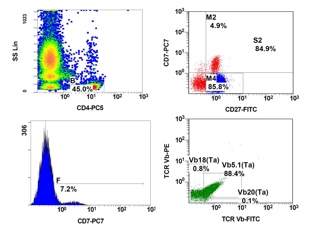 QUIZ(final) 86 man presented with erythroderma and lymphocytes with cerebriform nuclei, which were as  almost exclusively T4 lymphocytes, CD7-, CD27+ with selective  expression  Vβ 5.1. The above picture was compatible with #SEZARY syndrome verified by cutaneous biopsy  #hemepath