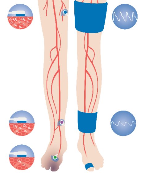 perimedgroup's tweet photo. If the only diagnostic test you are doing is an ABI, we can help you take it to the next level: ABI, TBI, PVR, tcpO2. Find out more at UHMS Annual Scientific Meeting, booth #103. #tcpO2 #toepressure #PADdiagnosis https://t.co/WDRN9Y8ihi