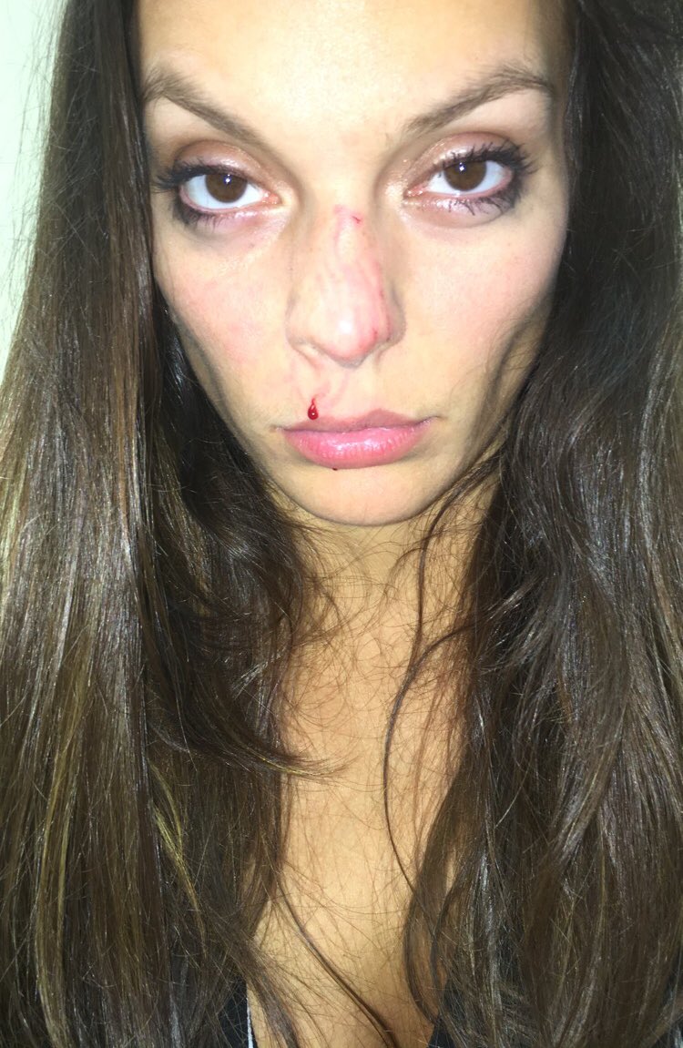 ashlethalweapon's tweet photo. Anyone else like to kiss doggos? #ConsentNeeded #Ouch #DogBite #itStartedOutWithaKiss #howDiditEndUpLikeThis #itWasOnlyaKiss https://t.co/Oz4RevmYWw