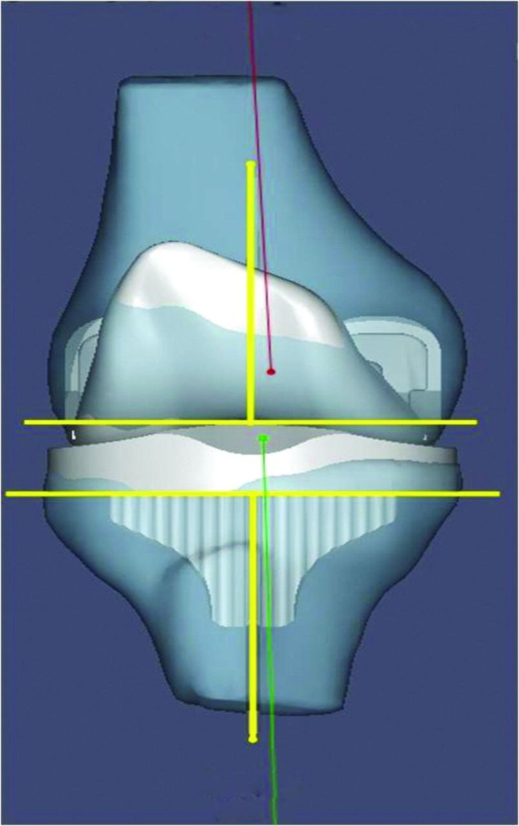 BoneJointJ's tweet photo. Total #knee #arthroplasty is now a more common procedure than total #hip arthroplasty but #satisfaction following the #surgery remains inferior; study finds that there is no difference between #kinematically and #mechanically aligned knee arthroplasties https://t.co/ENGSOT0NZh https://t.co/bTT6QGjbme