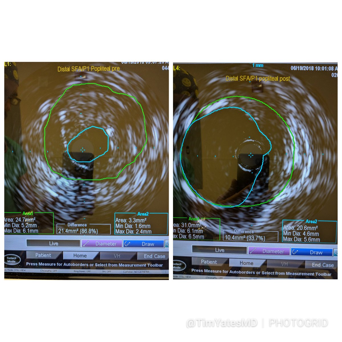 SOBE_Vascular's tweet photo. A case for #vesselprep and #IVUS for RC4 #CLI therapy. #Calcium -> enemy of #DCB. @bostonsci #Jetstream @BardPV #Ultrascore &amp; @BardPV #Lutonix with #nometalleftbehind for straight-forward TASC II type A occlusion (tibioperoneal occlusions too) @belzerj #CLIfighters @AMPSymposium https://t.co/xaAjSf230c