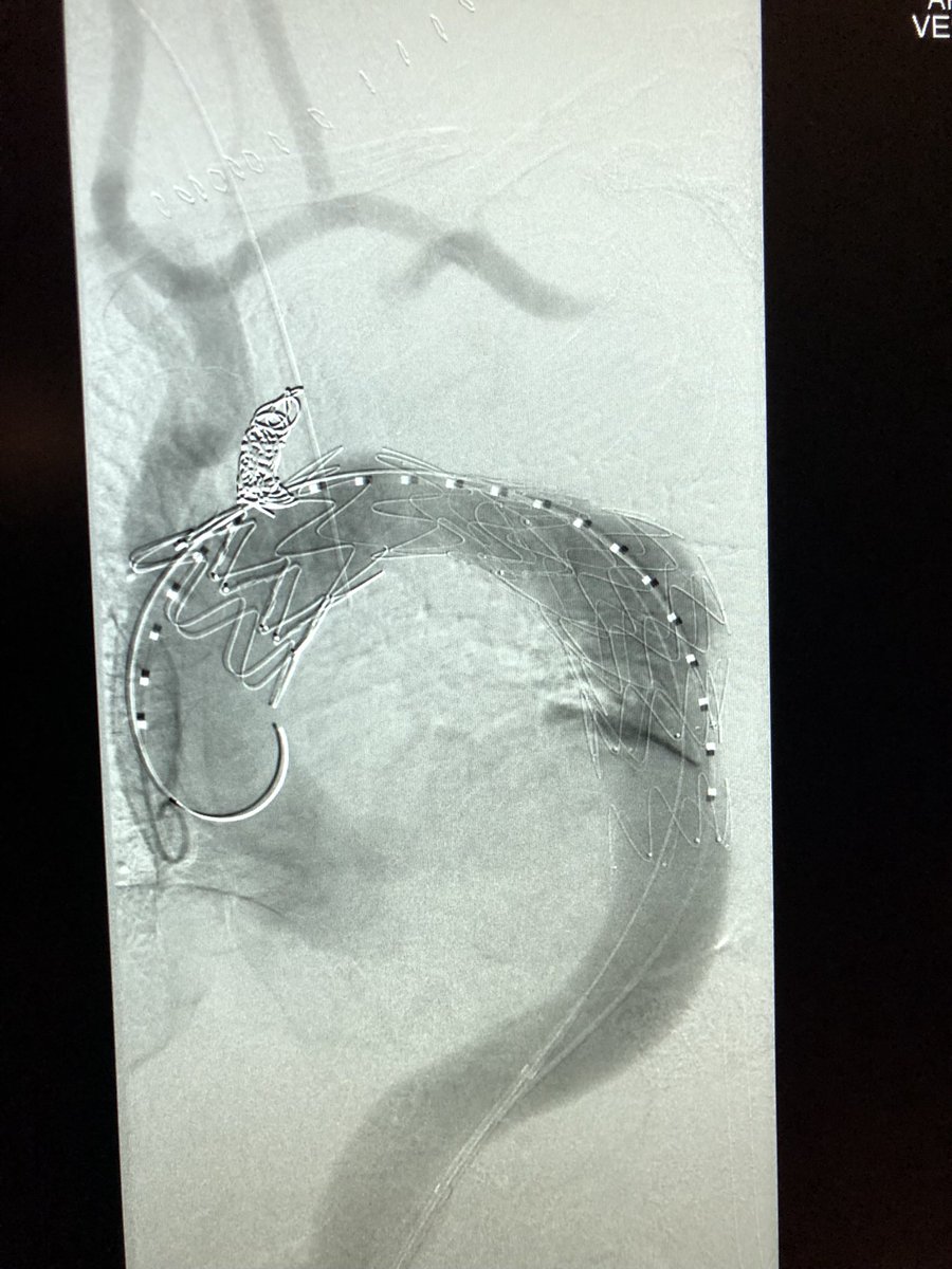 Live from #TCVCG 7cm arch aneurysm, right carotid to left subclavian bypass, left carotid transposition, TEVAR with @CookEVAR alpha. Courtesy of <a href="/crezayat/">crezayat</a> and <a href="/bbrener1/">bbrener</a>