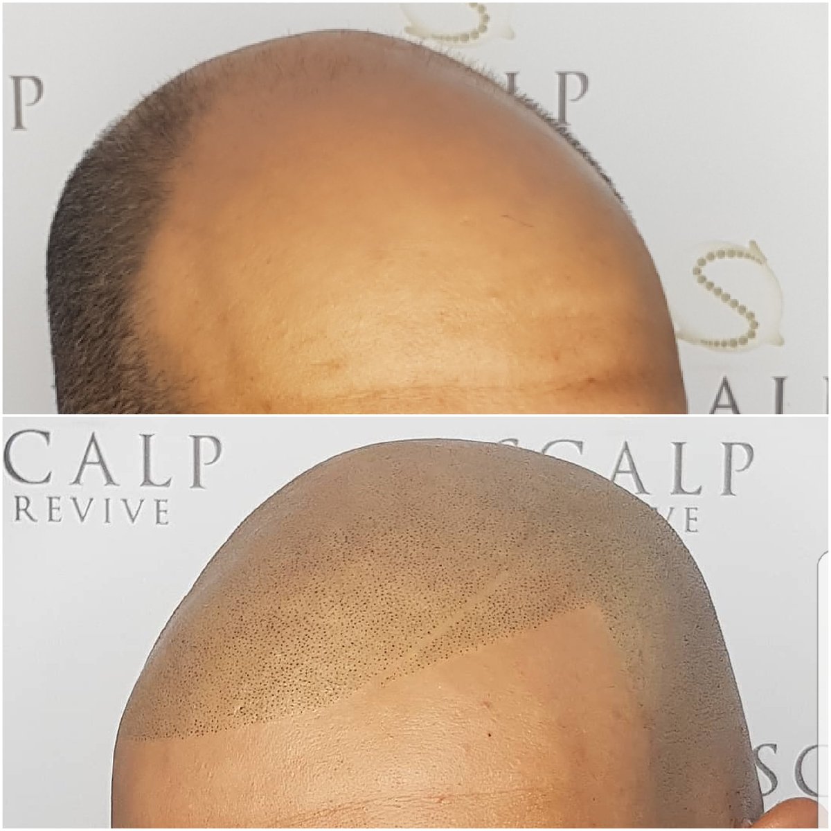 ScalpRevive's tweet photo. Bald to bold https://t.co/7SeXecrXai