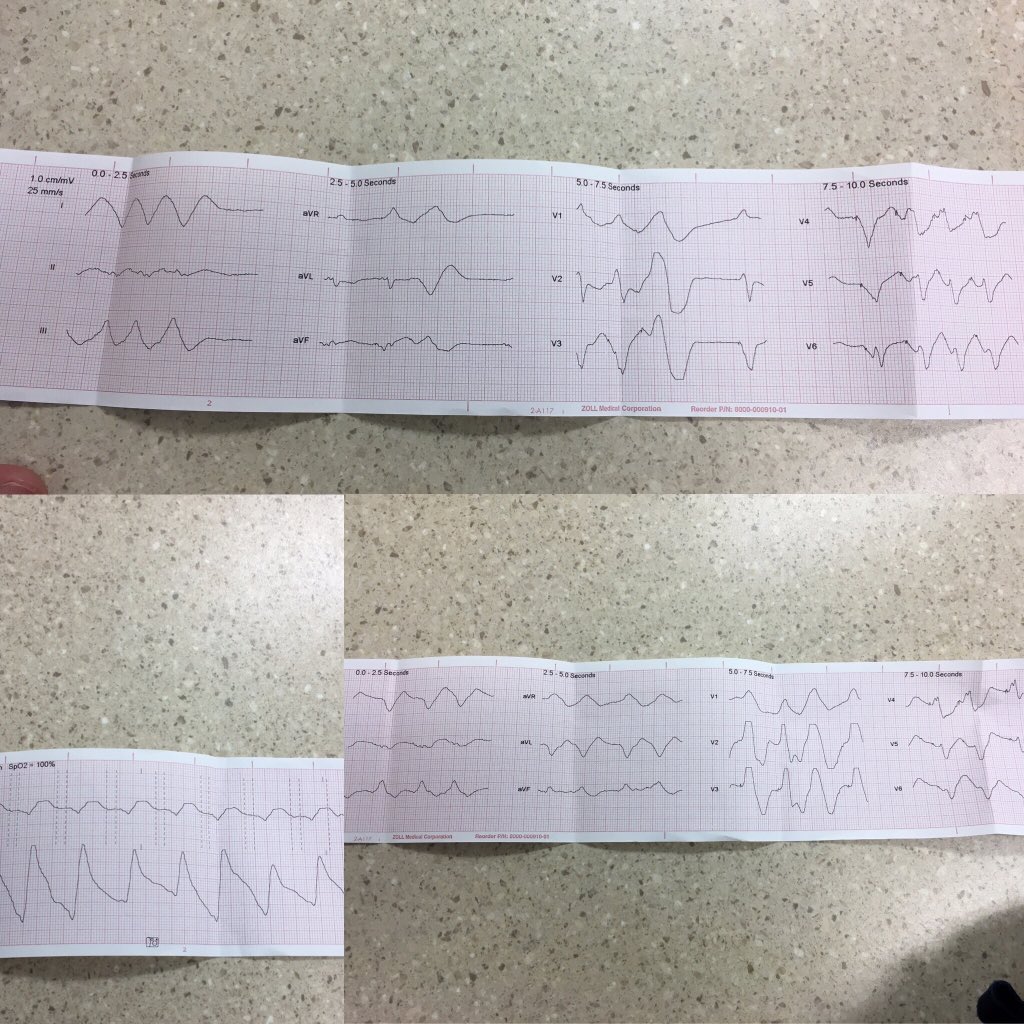 @EM_RESUS @drshahrul80 @MikeTanoue @ECGTalk @willsuh76 @DrSheilaSahni @chadialraies @sanjum @ECGQuizzes @EMS12Lead @ECGTraining @CMichaelGibson @pascalmeier74 @angioplastyorg @DrKevinCampbell @jemsconnect @ACCCardioEd @ACLSinstitute @ICU_Management @Med_FOAMed @DrBeniRusani @adibahabdlatif @MedCrisis @aalahmadmd Had these in a patient a while ago. Can’t recall her history, but know that she was pre-arrest when we got to her. After fluids and some oxygen she was up talking by the time we made it to the ED. Had we not been  so close, would’ve been able to give Calc. Gluconate & Salbutamol