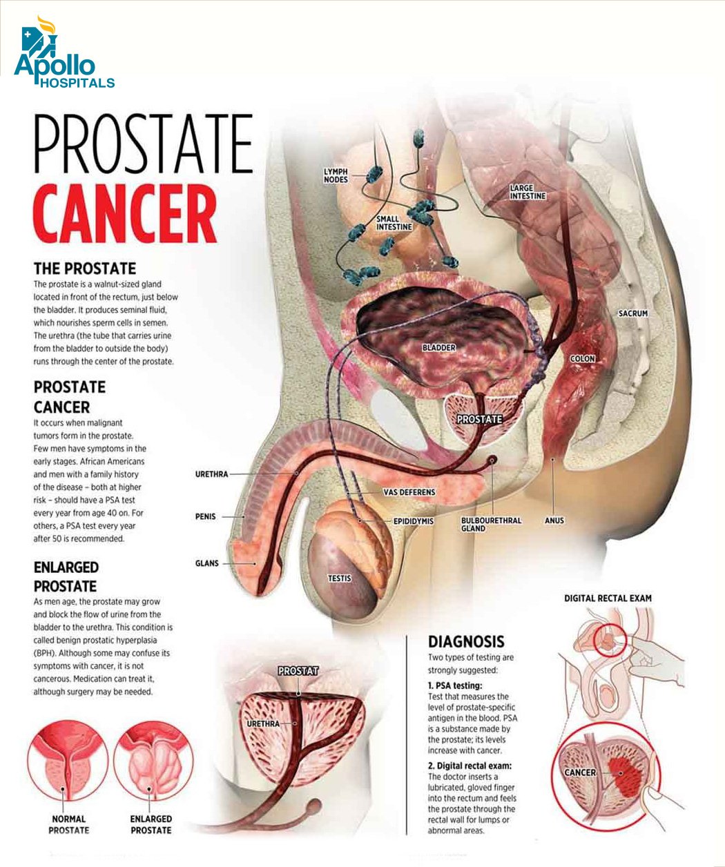 Foods To Avoid With Enlarged Prostate | Reduce Symptoms And Risk Of Prostate Cancer - Youtube