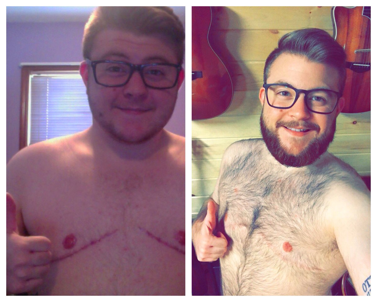kjcat92's tweet photo. Showing off my designer nipples because it’s our 4 year anniversary! #topsurgery #LGBTQ #transmasculine #ftm #doubleincision https://t.co/KymhW5U4Lg