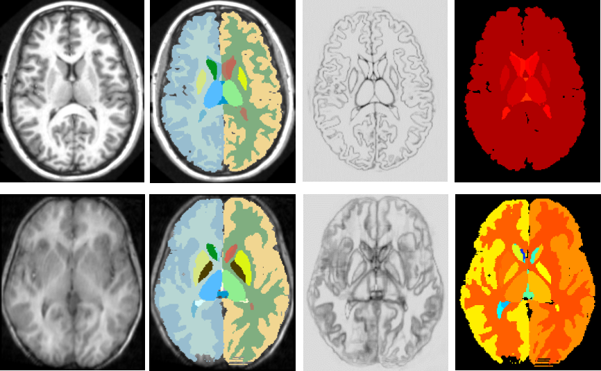 AI-Med: Artificial Intelligence in Medical Imaging (@ai_medic) on Twitter photo Uncertainty estimation (<a href="/yaringal/">Yarin</a>) in F-CNN brain segmentation for automated quality control arxiv.org/abs/1804.07046 #miccai2018 #miccai #DeepLearning #brain #papers #uncertainty #bayesian <a href="/SAPLeonardo/">SAP Leonardo</a> <a href="/ZDBayern/">Zentrum Digitalisierung.Bayern (ZD.B)</a> <a href="/nvidia/">NVIDIA</a> <a href="/LMU_Muenchen/">Universität München</a> <a href="/abzz4ssj/">Abhijit Guha Roy</a> <a href="/wonnga/">Christian Wachinger</a> Uncertainty estimation (<a href="/yaringal/">Yarin</a>) in F-CNN brain segmentation for automated quality control arxiv.org/abs/1804.07046 #miccai2018 #miccai #DeepLearning #brain #papers #uncertainty #bayesian <a href="/SAPLeonardo/">SAP Leonardo</a> <a href="/ZDBayern/">Zentrum Digitalisierung.Bayern (ZD.B)</a> <a href="/nvidia/">NVIDIA</a> <a href="/LMU_Muenchen/">Universität München</a> <a href="/abzz4ssj/">Abhijit Guha Roy</a> <a href="/wonnga/">Christian Wachinger</a>