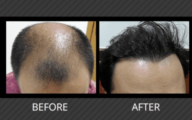 Maxim Hair Restoration (@MaximHairRestor) / Twitter Maxim Hair Restoration (@MaximHairRestor) / Twitter