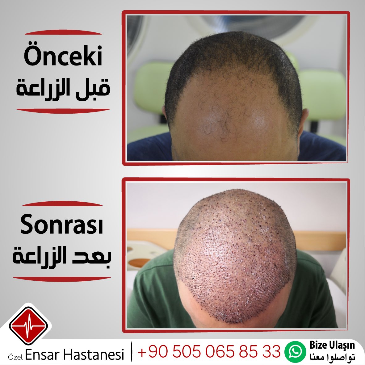 افضل النتائج وانسب الاسعار لزراعة الشعر، فقط في مستشفى انصار!

00905050658533

#ensarhastanesi #saçekimi #fue #saç #istanbul #esenler #türkiye #زراعة_الشعر #زراعة_الشعر_في_تركيا #زراعة_الشعر_في_اسطنبول #زراعة_شعر #شعر #تركيا #اسطنبول #اسطنبول_تركيا #hairtransplant #hair #turkey