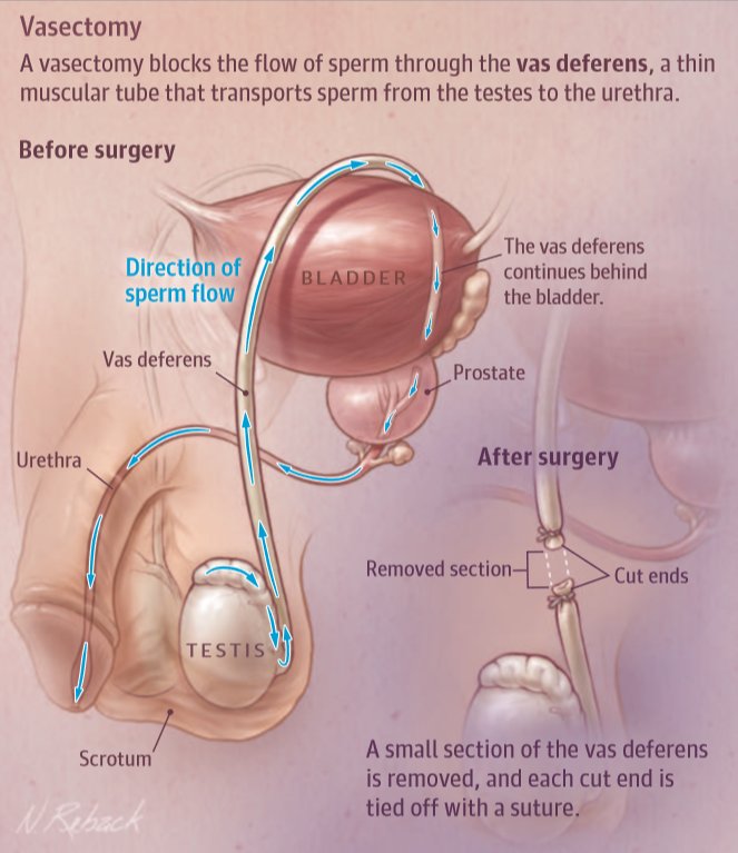 In this JAMA Patient Page, researchers describe the vasectomy procedure and follow-up practices. Learn more; ja.ma/2taPprr #Vasectomy