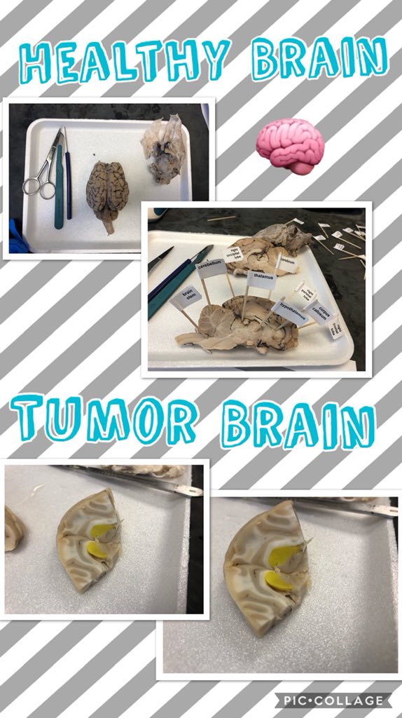 DeBold_Science's tweet image. Day 3: PLTW-Medical Detectives Sheep Brain Dissection 🧠🖋 Diagnosing a Neurological Disorder @MrsLCumming @BernardMiddle @MEHLVILLE1 #PLTW #MedicalDetectives #BrainDissections #Diagnosis #Tumor #RightLobeControlsLeftside