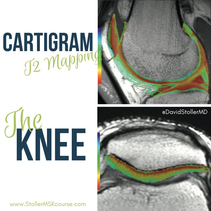 DavidStollerMD's tweet photo. CartiGram T2 mapping is a noninvasive technique used to detect changes in the collagen component of the extracellular matrix of cartilage (shown on sagittal and axial knee images) #StollerMSKcourse #TheKnee #MRI #orthopaedics #sportsmedicine #radiology #imaging #T2Mapping #MSK https://t.co/EMMNkYNZ24