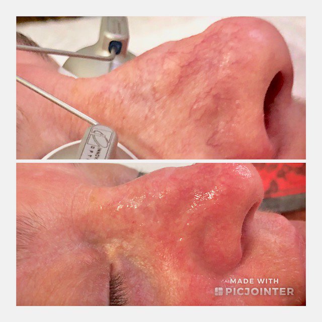 vita_skin's tweet image. Eliminate with excel V laser. The excel V laser treatment can eliminate vascular veins.
Here is Vita's client immediately after treatment. The best results are seen within few days.
#excelV #veintreatment #capillaries #skincare #vitatheskinwhisperer
