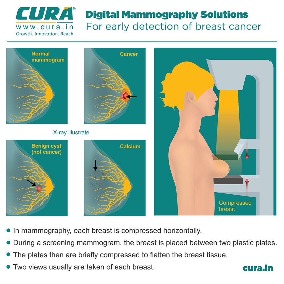 CURA_HealthCare's tweet photo. CURA offers advanced #mammography solutions for the early detection of #breastcancer. With options to process images with desired variations of brightness and contrast, it also facilitates real-time image acquisition. #BreastCancerAwareness #WomensHealth https://t.co/6b3UuG1TJI
