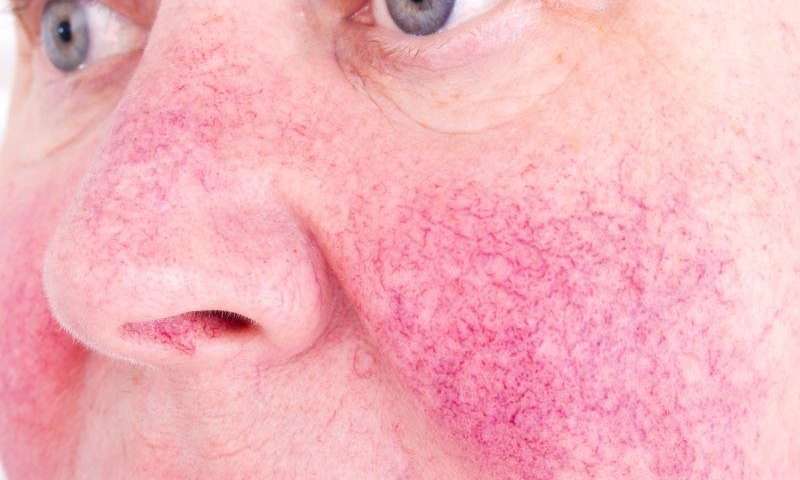 Could you have #rosacea? #Health #Skin #Dermatology #Acne #Discoloration #SkinIrritation ow.ly/74hG30kxUed