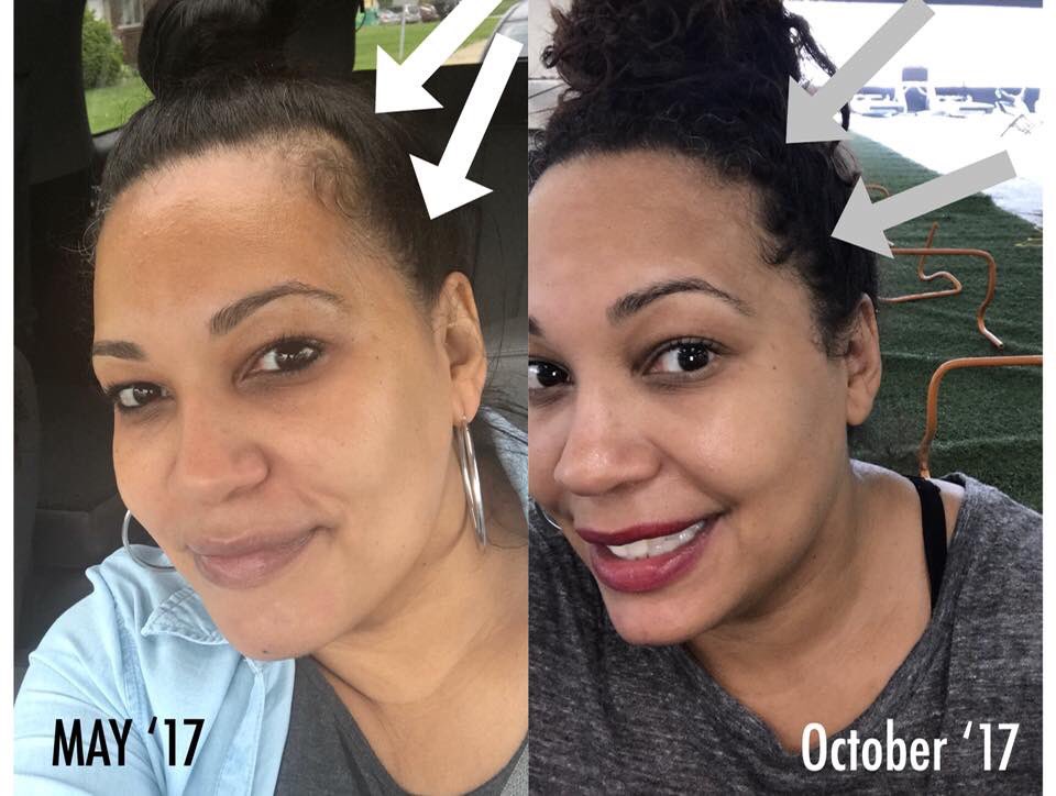 DamTheButterfly's tweet photo. Fellow Warriors who suffer from #ThyroidDiseaseHairLoss, we are happy to have found a toxin-free product that helps us with hair loss. Attached below in tweet #2 is a testimony from a Fellow #ThyroidDisease Warrior. 🦋 https://t.co/lYHrT4IrrW