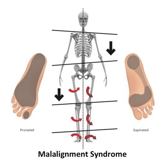 Coaching wisdom. 80% of the population are ‘malaligned’. If in doubt check their footprints! Read all about it leesaxby.com #functionalfeet