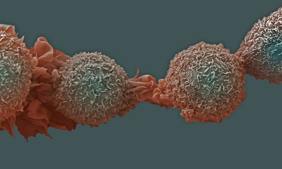 Crianças que superam câncer têm doenças crônicas na vida adulta, diz estudo crwd.fr/2wQ9BRL