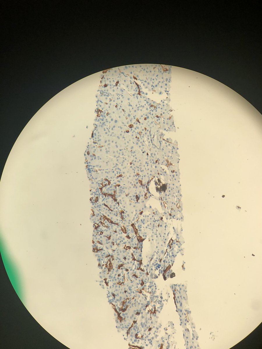 Neuygn's tweet photo. The most satisfying case of HCC, with CD34, glypican3 and reticulum @ArchivesPath @PathoPictures @hepatopatho https://t.co/sdErL2VLLZ