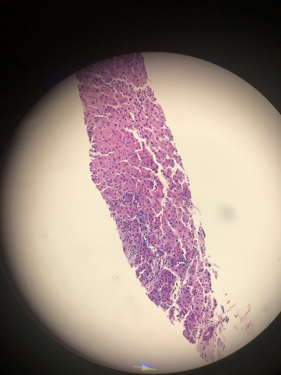 Neuygn's tweet photo. The most satisfying case of HCC, with CD34, glypican3 and reticulum @ArchivesPath @PathoPictures @hepatopatho https://t.co/sdErL2VLLZ