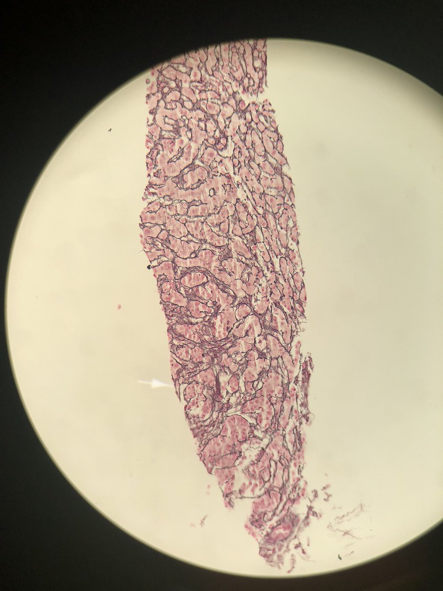 Neuygn's tweet photo. The most satisfying case of HCC, with CD34, glypican3 and reticulum @ArchivesPath @PathoPictures @hepatopatho https://t.co/sdErL2VLLZ