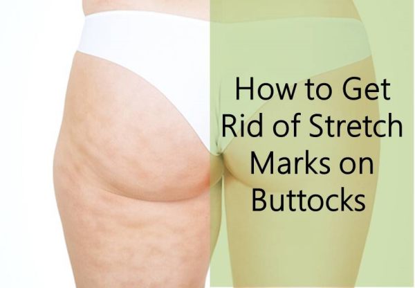 Masaccio podning Erhvervelse DyingToBeBootyful on Twitter: "How To Get Rid Of Stretch Marks (Butt, Thigh  &amp; Hips) https://t.co/2U6c1RFgZ0 #Rid #Butt #Hips #Thigh #Stretch # Buttocks #Naturally #DGW #DGWfilms https://t.co/lRm9zEnoux" / Twitter