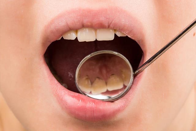 MabryConiglio's tweet photo. The most common sign of tartar is a yellow or brown deposit between the lower front teeth or at the gum line. The only way to remove tartar completely is to see a dental hygienist for a cleaning. #callnow #prventivecare (817) 329-6677 https://t.co/TxOfB1yWXD