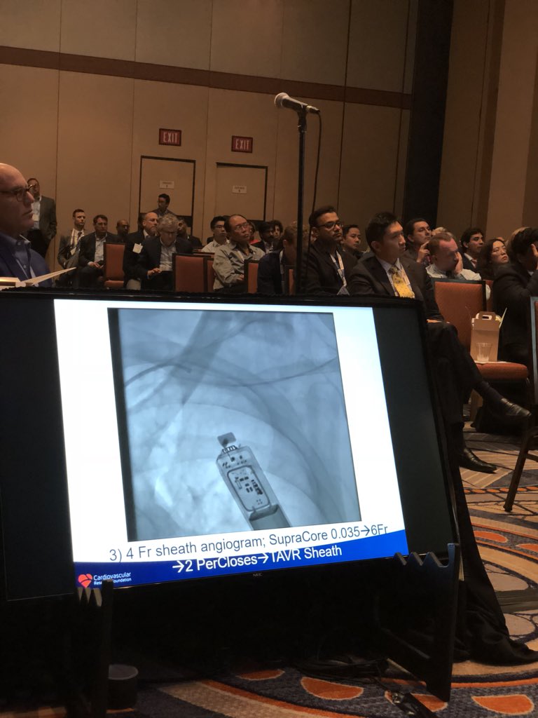 chadialraies's tweet image. Stiff wire is better to drive the #PerClose closure device for axillary to over come the track especially in patients with big chest #TVT2018 #PercAx @philgenereux @DrAmirKaki @MartyMleon #ACCIC #ACCEarlyCareer