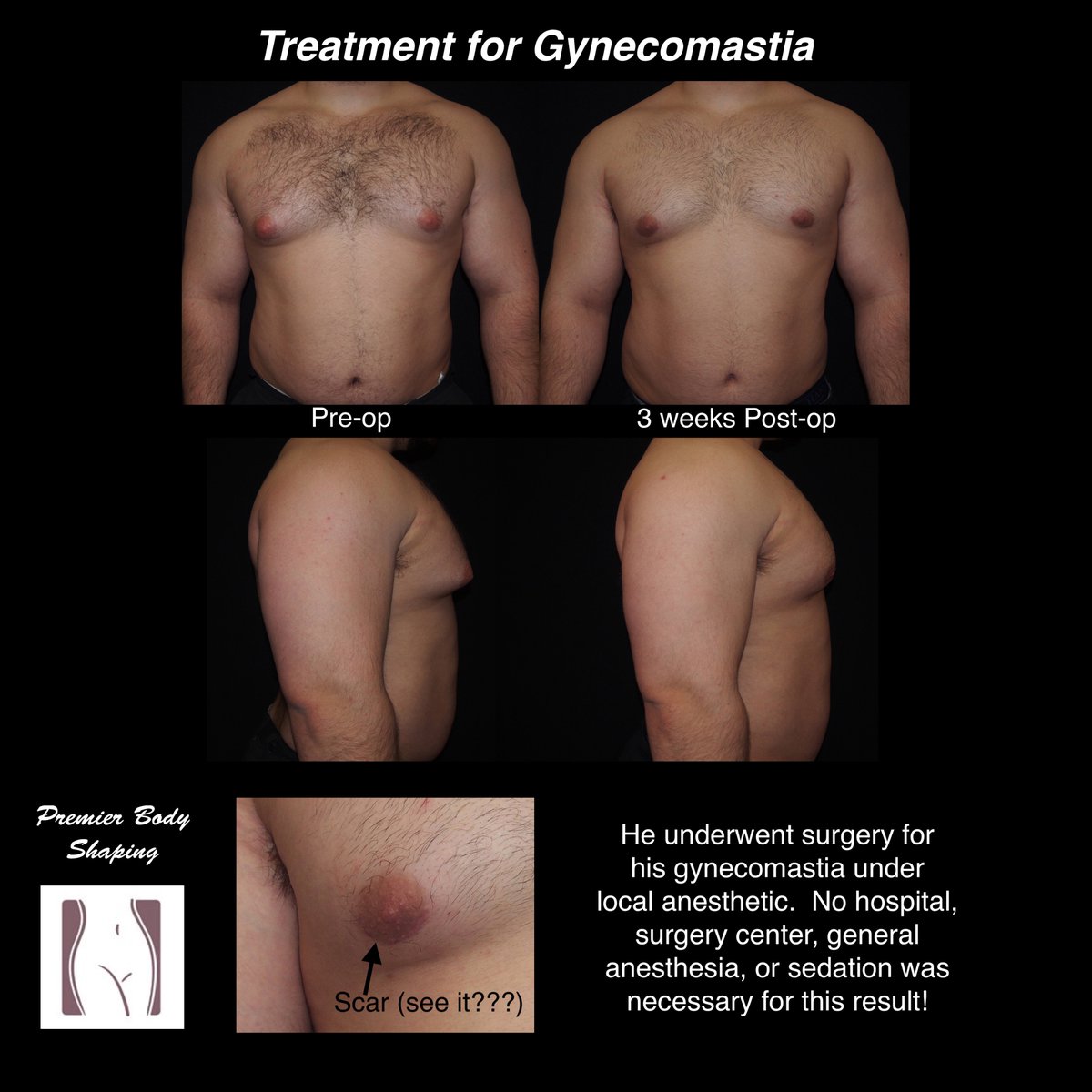 He was very happy...  especially since I did this in the office under local anesthetic.  Dr. Jaime Bastidas <a href="/premierbodynj/">Premier Body Shaping</a> #plasticsurgery #gynecomastia