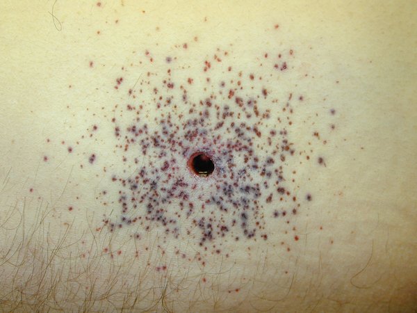 EBmedicine's tweet photo. Ali Raja is ballin again! In ballistic #trauma, soot and stippling are both indicative of close distance wounds (<1 m) @AliRaja_MD #CDEM18 https://t.co/xbgxWEoblH