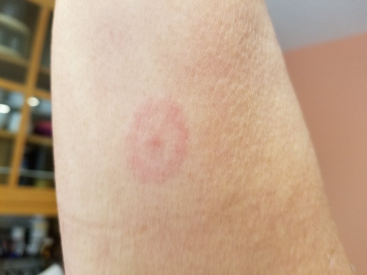 tick bite bullseye