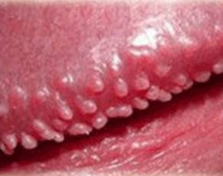 jeffpegain's tweet photo. Do You Have This In Your #Penis? https://t.co/cG5wn7QYhl #pearlypenilepapules #pearlypapulesremovals #health #healthtips #penisdisease #Menshealth #menshealthua #genitalwarts #warts #wartsremoval #pearlypenilepapulesremoval #pearlypenileremoval https://t.co/NQHwrj098O