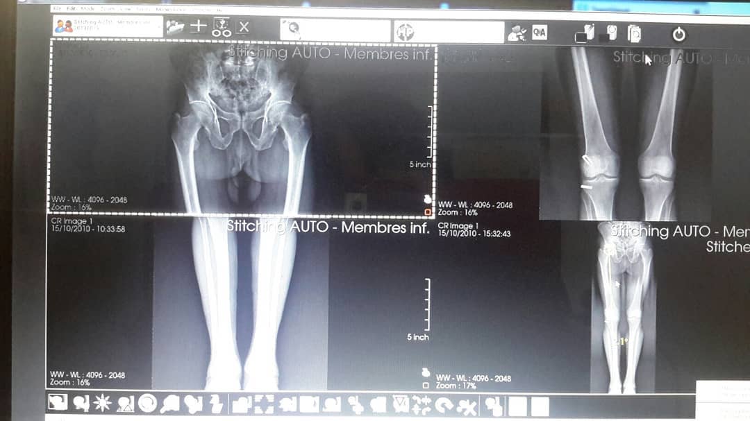delysch's tweet photo. Éste software permite hacer #Stitiching. De tu detector normal procesas extremidades completas. Además post procesas imágenes de Mamografía, Tomorafía, Ultrasonido. Preparando lanzamiento @EquipMedShop #Latam #Dicom #ImagenesMédicas #WorkStation #SoftwareSolution #Training https://t.co/p7e7qjveIS