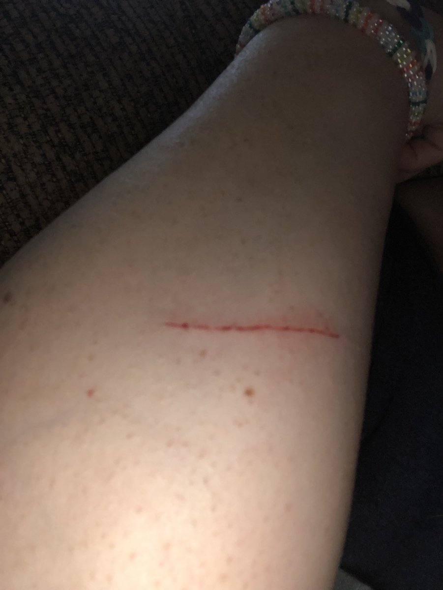 NikkiCPhT's tweet photo. How is it that I get a cut and I have no clue where it came from?! WTH?! 😑 #itstings #ouchy #whodidthistome https://t.co/LoQ2doqauh