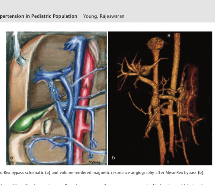 Victoria Young (@vyoungmd) on Twitter photo I’m a published artist!!! #grateful #IR #rexshunt #MedicalIllustration Thank you #Thieme #SeminarsInIR <a href="/JLR_IR/">Jamie RiChard</a> <a href="/shamitsdesai/">Shamit Desai MD</a> @drseedial I’m a published artist!!! #grateful #IR #rexshunt #MedicalIllustration Thank you #Thieme #SeminarsInIR <a href="/JLR_IR/">Jamie RiChard</a> <a href="/shamitsdesai/">Shamit Desai MD</a> @drseedial