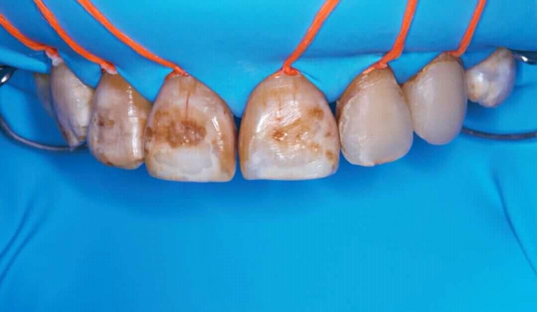 OviDentalGo's tweet image. Clinical Case #OperativeDentistry
#Odontology #Composite #DentalVeneer
facebook.com/OVIDentalGo/po…