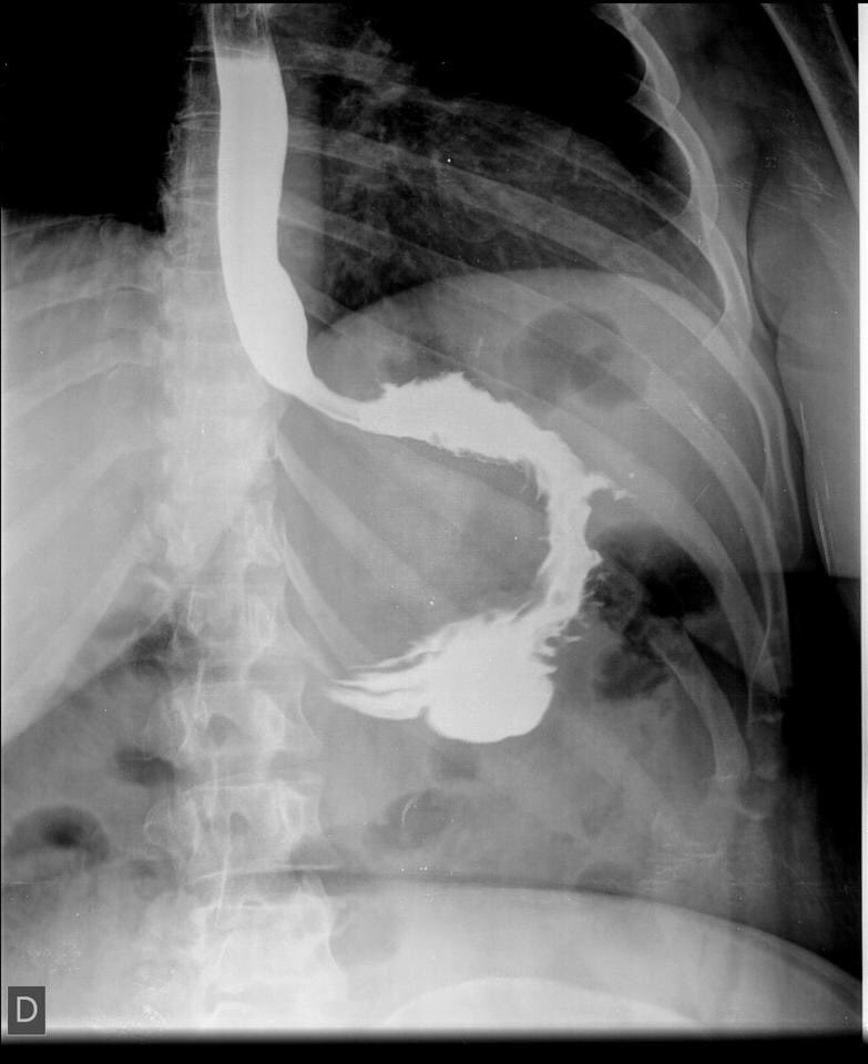 4 years since we did the first in Europe #Endoscopicsleevegastroplasty. Big step forward for our #bariatricendoscopy activity. #endoscopia #bariatrica Thanks @HMHOSPITALES @MPGN46 @APOLLO_ENDO