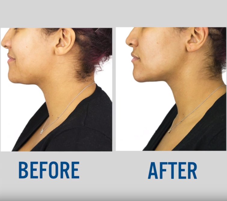 upyoursgravity's tweet photo. The ChinUp Mask shrinks and tightens the neckline whilst defining your chin and jawline. 

It takes you just 30 minutes to achieve phenomenal results that last for days!

#beforeandafter #slimming #nonsurgical #blogger #define https://t.co/Z3w8TiuhkH