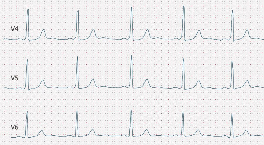ecgbuddy's tweet photo. Monday, Monday..... Time for a new ECG case! Have a great day, lovely ones.
Your 25-year-old patient complains of severe episodes of palpitations. What's the problem? #mondaymotivation #ecgbuddy #studybuddy #ecg #ecginterpretation #ecgreading #ecgcourse #ER #hospitallife https://t.co/JbDRtnCjhF