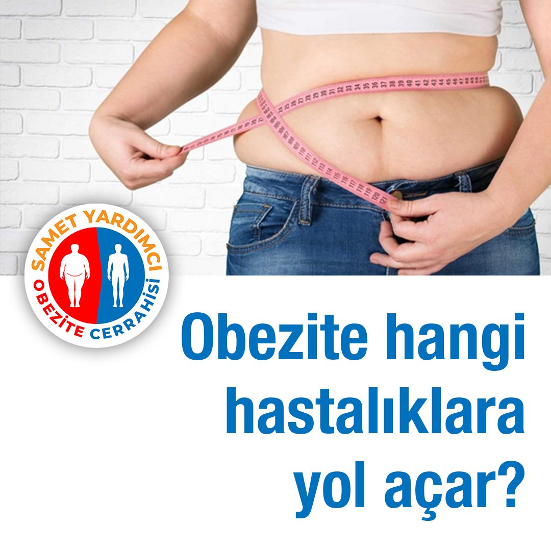 #obezite #hipertansiyon #kalphastalıkları #siroz #reflü #safrataşı #kireçlenme #böbrekyetmezliği #bağırsakkanseri #pankreaskanseri #akciğerhastalıkları #migren #gut gibi hastalıklara yol açabilir #obezitecerrahisi #mideküçültme #tüpmide #diyabet #metabolikcerrahi #şekerhastalığı