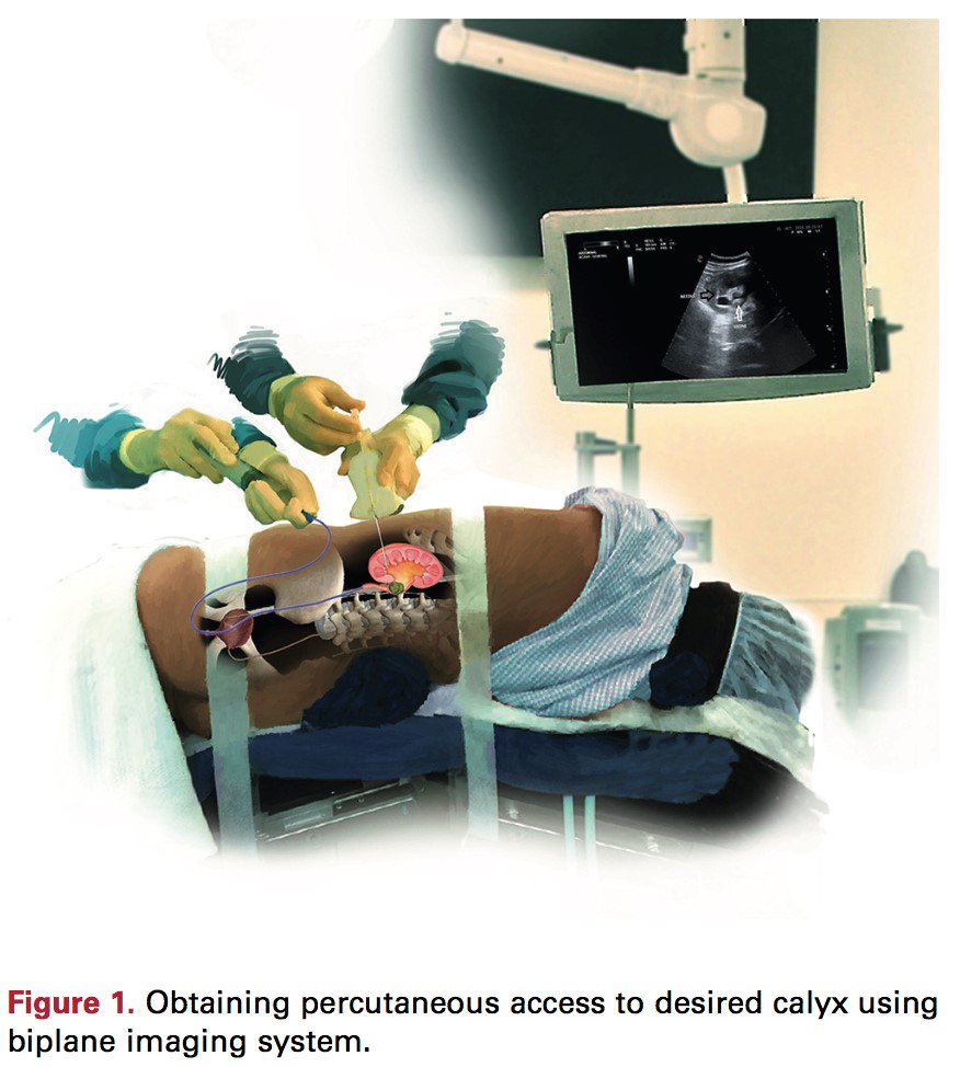 JUrology's tweet photo. Ultrasound access for #PCNL in Flank position: 
access achieved in all but 1 of 529 pts. 
Clavien  grade 3 comps. in 2.8%. 
Blood transfusion in 7.1%. 
https://t.co/GjPnVyvBH7 https://t.co/llDTRRsmIr