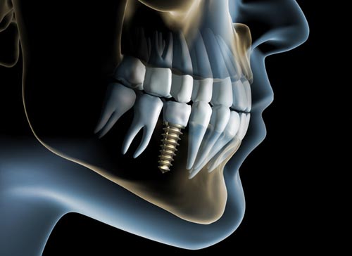SensitiveCare's tweet image. Dental implants are changing the way people live! A dental implant is an  artificial tooth root (similar in shape to screws) that is placed into  your jaw they are designed to provide a foundation for replacement teeth  that look, feel, and function like natural teeth.