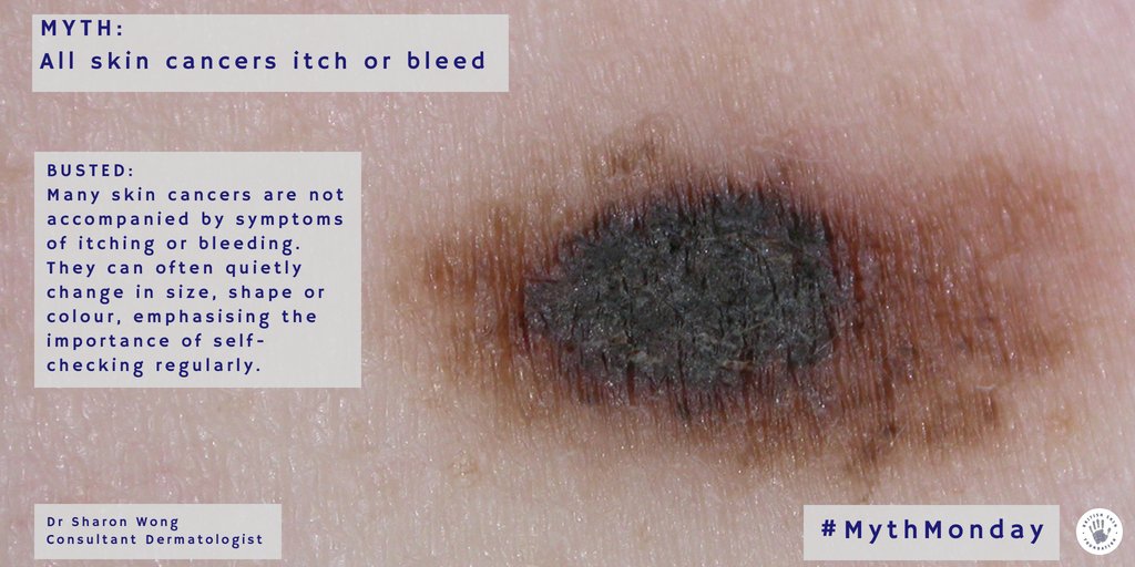 #ICYMI Today's #MythMonday comes from <a href="/DrSharonWong/">Sharon Wong</a>. Make sure you're checking your moles regularly for any changes. If you're concerned then visit your GP or dermatologist. (Image courtesy of Dr Jonathan Bowling).