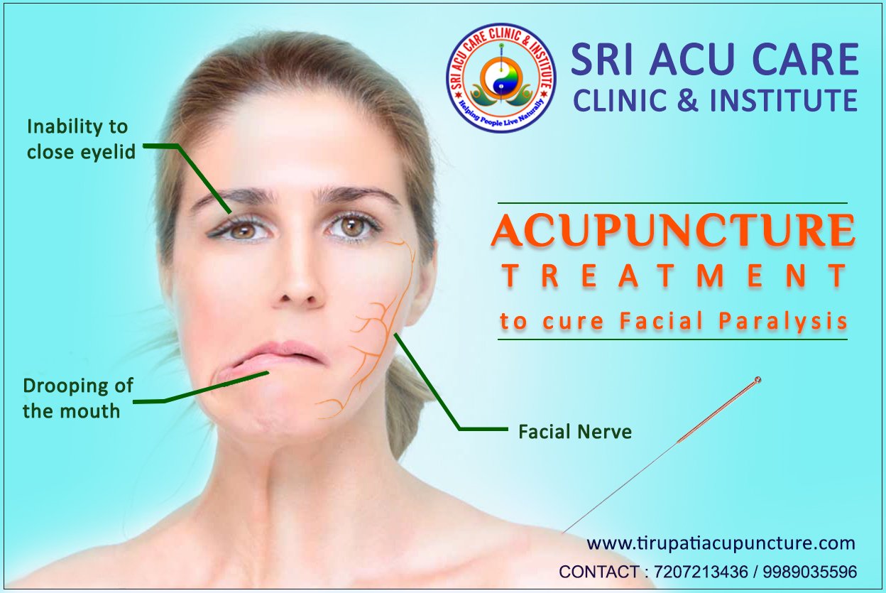 The Acupuncture Treatment For Paralysis Download Pdf Bonsai Books Pdf