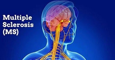 secretsofaidsa1's tweet image. SCIENTIFIC RESEARCH PROVES VACCINES CAUSE MULTIPLE SCLEROSIS buff.ly/2tD6R7u