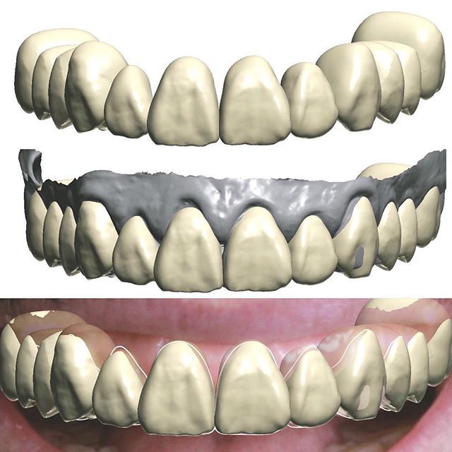 LorantStumpf's tweet photo. The predesign is #ready for our #upcoming #digital #course with @vicenteberbis in #spain this #week we will #cover #everything about #latest #digital #trends and #techniques Pure asymmetrical shape selection-> total natural appearance #3shape #3shapetrios #3shapedesign #ivoc… https://t.co/wuJNxrBQwD