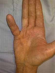 bone_reports's tweet image. #Dupuytren's disease condition that affects the #fascia in the palm and fingers.
For more check the below link:
bone.imedpub.com