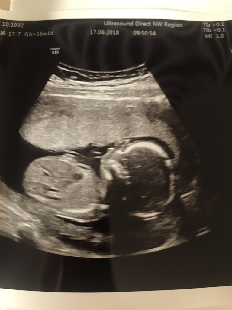 JordanParker7's tweet image. Roll on December #babyNo2 👶🏻